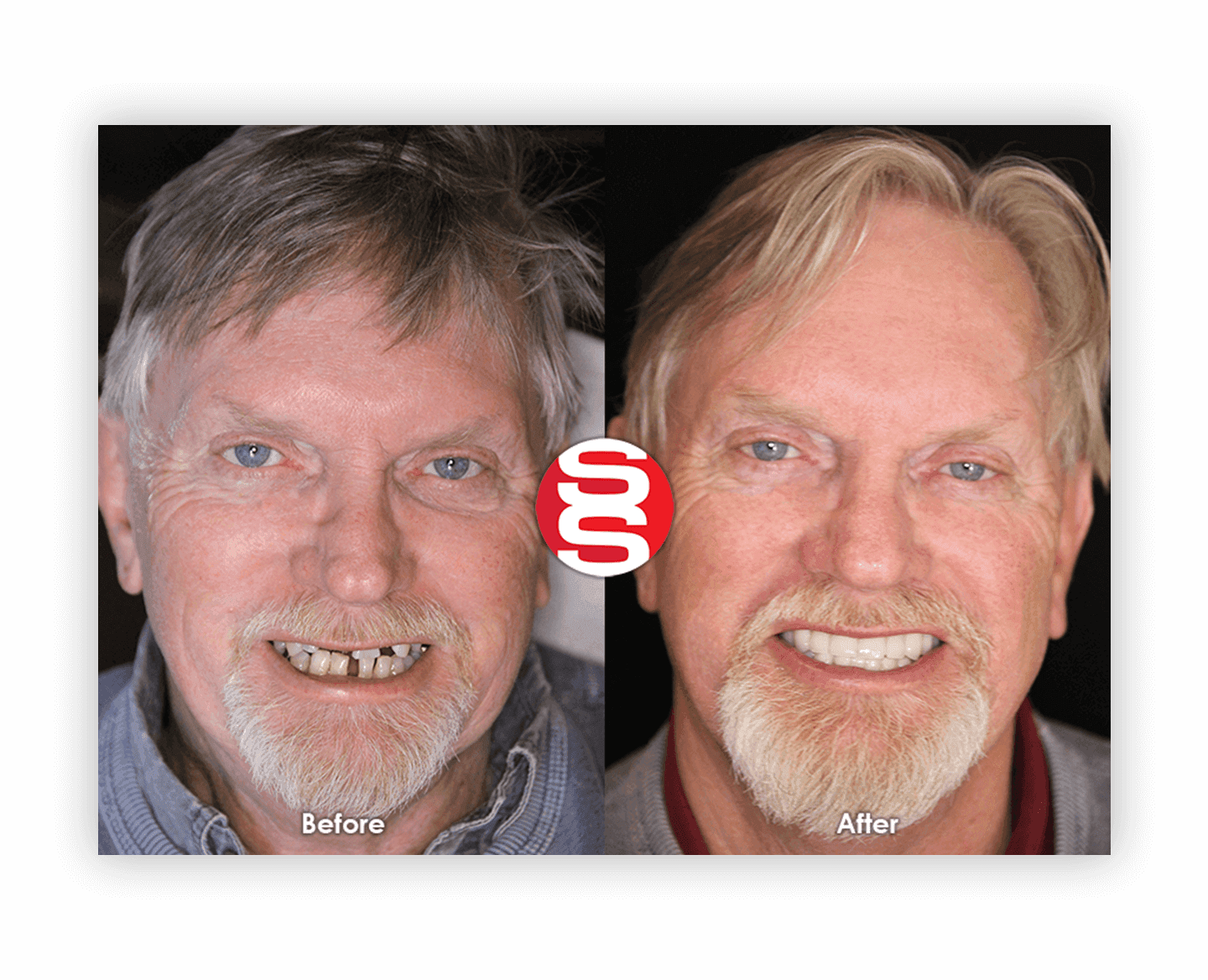 Old Man Smile Before After